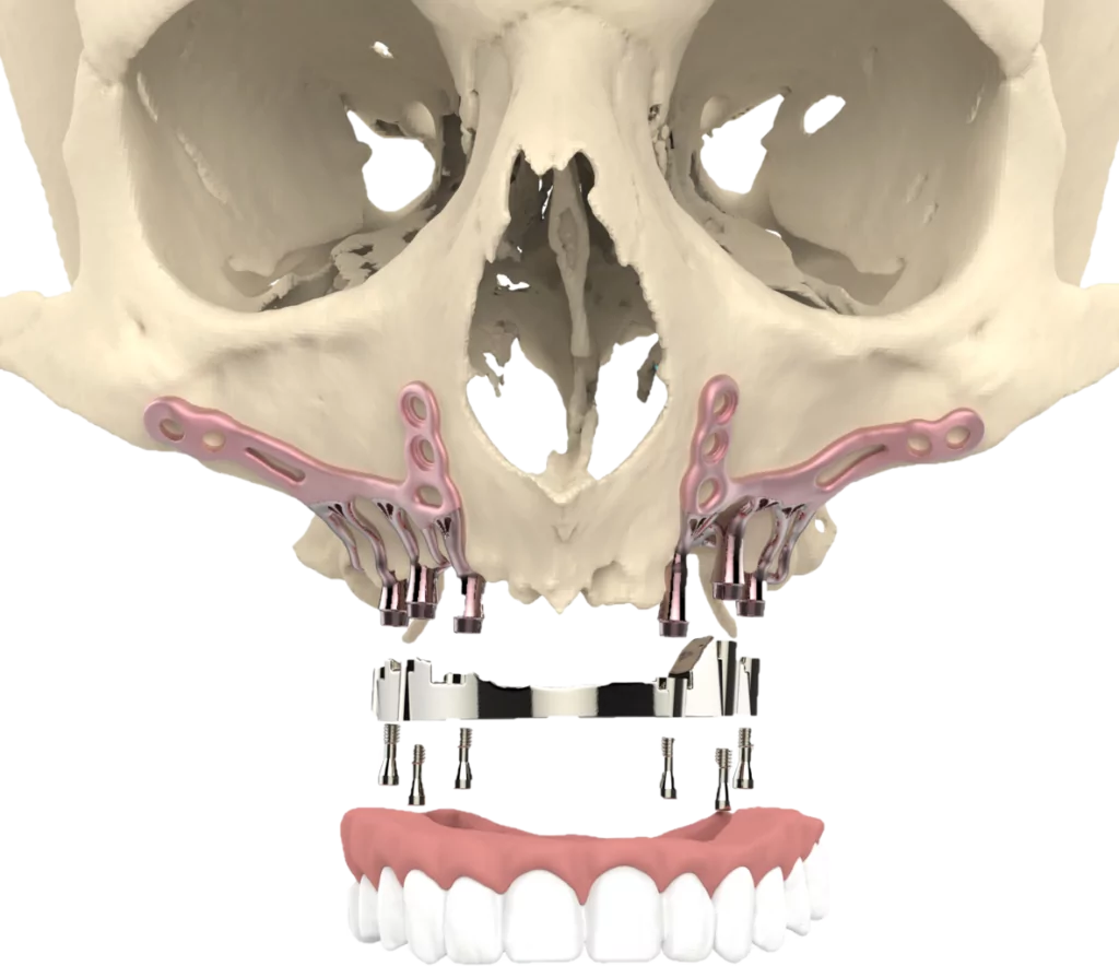 3D-geprinte kaakimplantaten